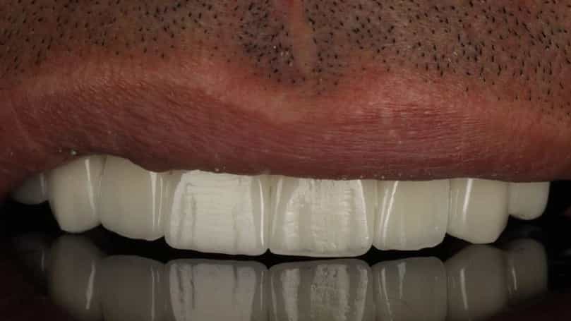 اصلاح طرح لبخند اصولی با تکنولوژی روز دنیا در رشت