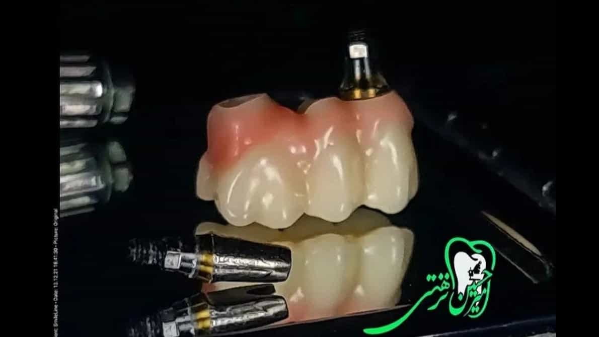 ساخت پروتز متکی بر ایمپلنت